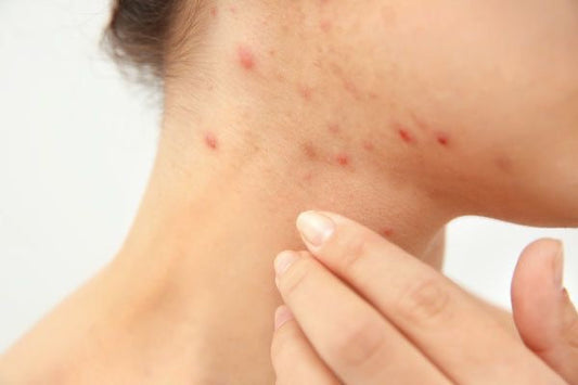 Acné hormonale : comprendre et agir naturellement